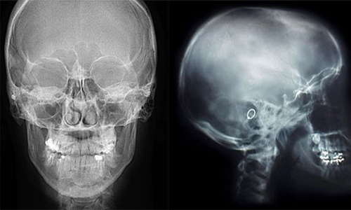Рентген головы по Шулеру